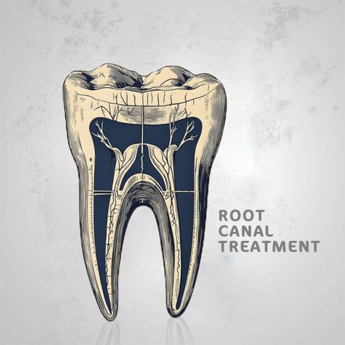 Understanding Root Canal Treatment