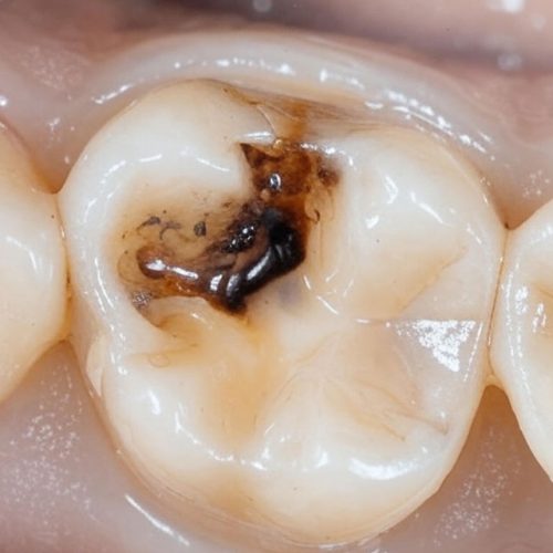 Tooth Caries (Cavities): Causes, Early Signs, Stages, Prevention, and Treatment