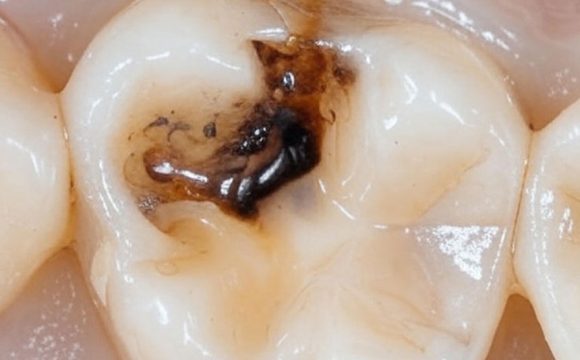 Tooth Caries (Cavities): Causes, Early Signs, Stages, Prevention, and Treatment
