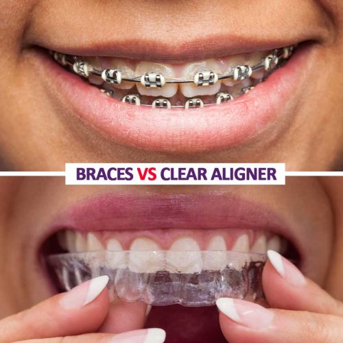 Braces vs. Clear Aligners: The Ultimate 2026 Comparison Guide (Pros, Cons, Costs, Effectiveness & FAQs)
