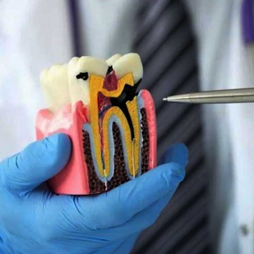 Tooth Treatment (Root Canal Therapy – RCT) and Replacement Options: A Complete Patient Guide to Saving or Replacing Teeth