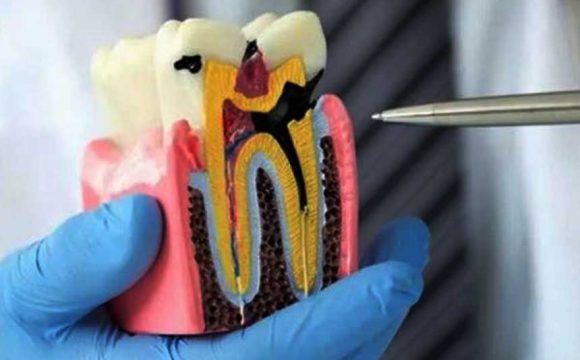Tooth Treatment (Root Canal Therapy – RCT) and Replacement Options: A Complete Patient Guide to Saving or Replacing Teeth