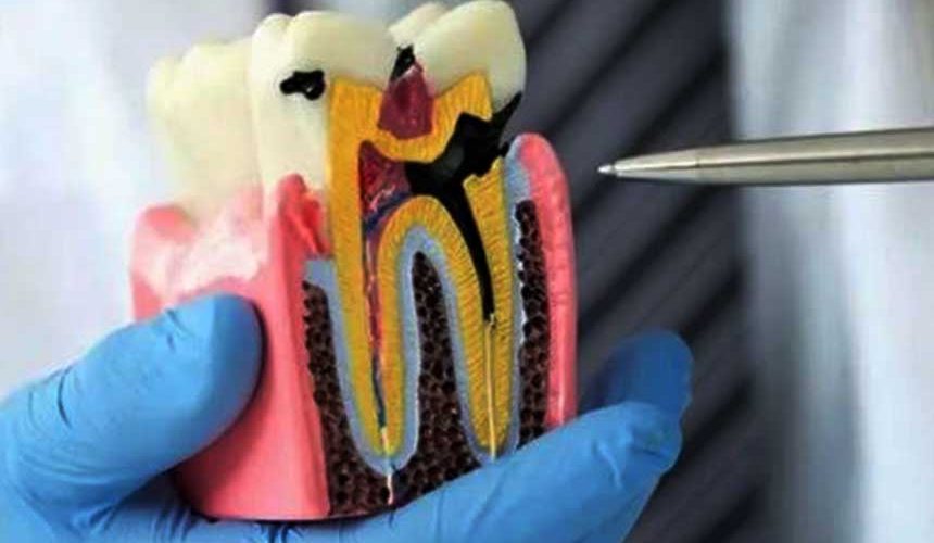 Tooth Treatment (Root Canal Therapy – RCT) and Replacement Options: A Complete Patient Guide to Saving or Replacing Teeth