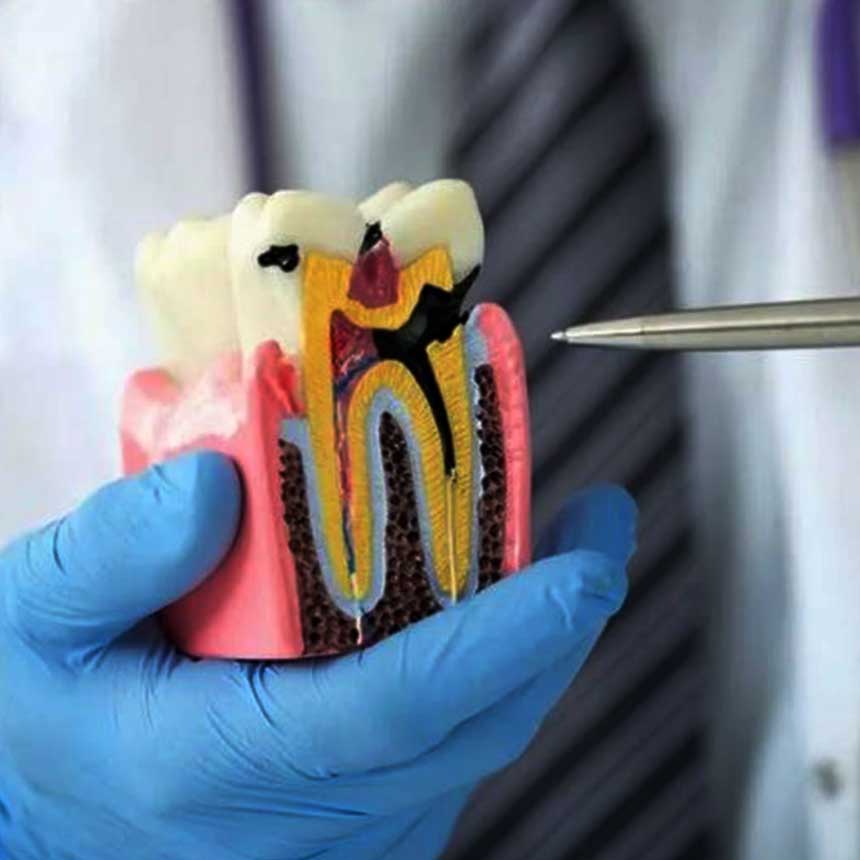 Root-Canal-Therapy--RCT-front Tooth Treatment (Root Canal Therapy – RCT) and Replacement Options: A Complete Patient Guide to Saving or Replacing Teeth