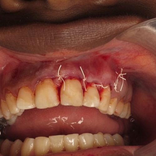 Apicoectomy