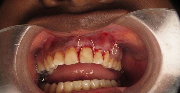 Apicoectomy