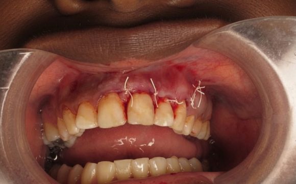 Apicoectomy
