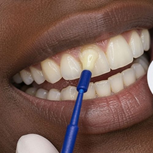 Fluoride Therapy