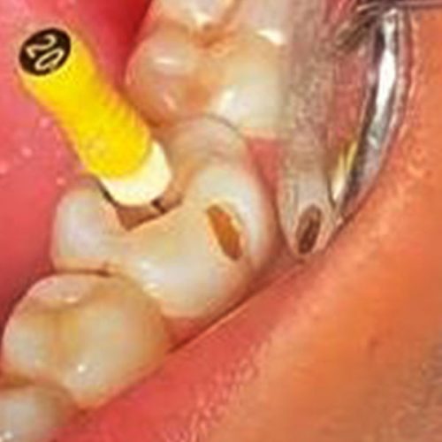 Root Canal Treatment