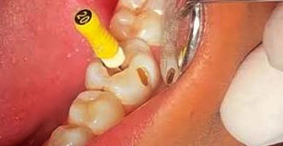 Root Canal Treatment