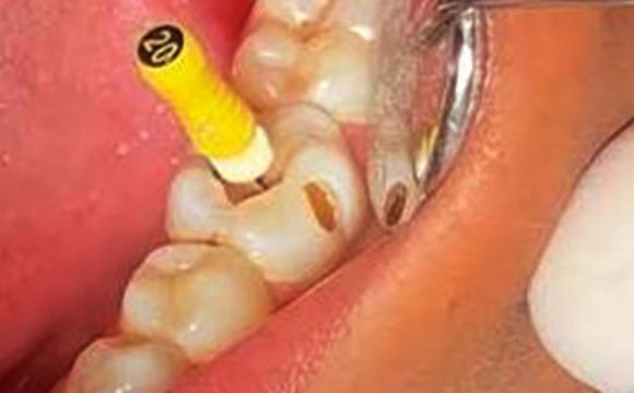 Root Canal Treatment