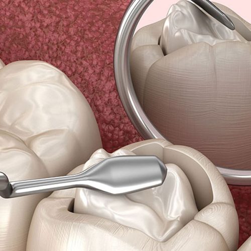 Composite & GIC Fillings