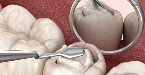 Composite & GIC Fillings