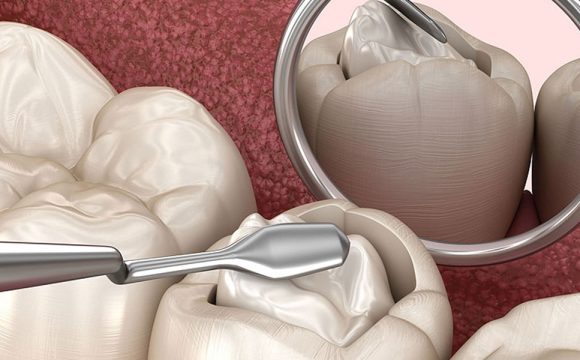 Composite & GIC Fillings