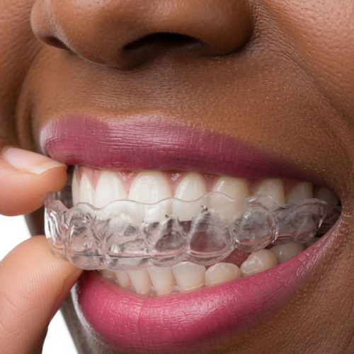 Clear Aligners