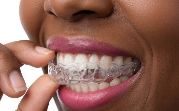 Clear Aligners