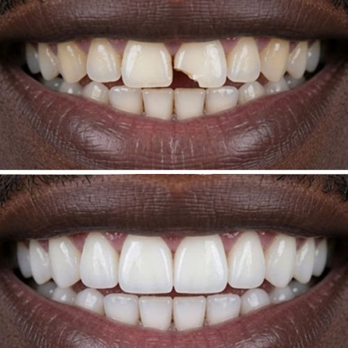 Composite Buildup