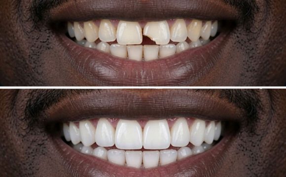 Composite Buildup