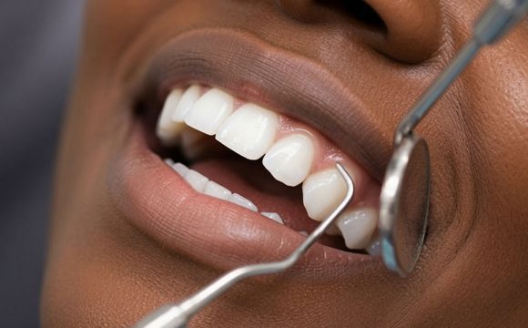 Dental Curettage